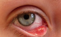Red painful irritation on the inside of the eyelid from stye.