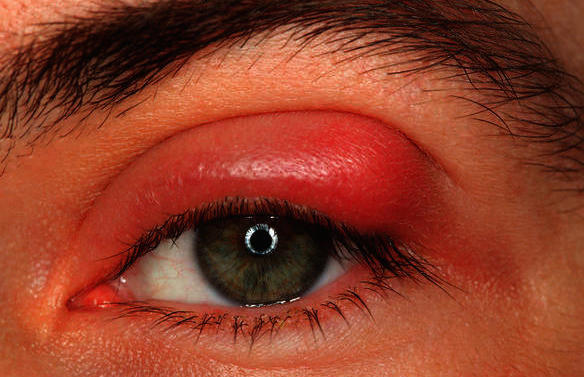 Hordeolum Image of swollen eyelid due to a stye infection in upper eyelid. 