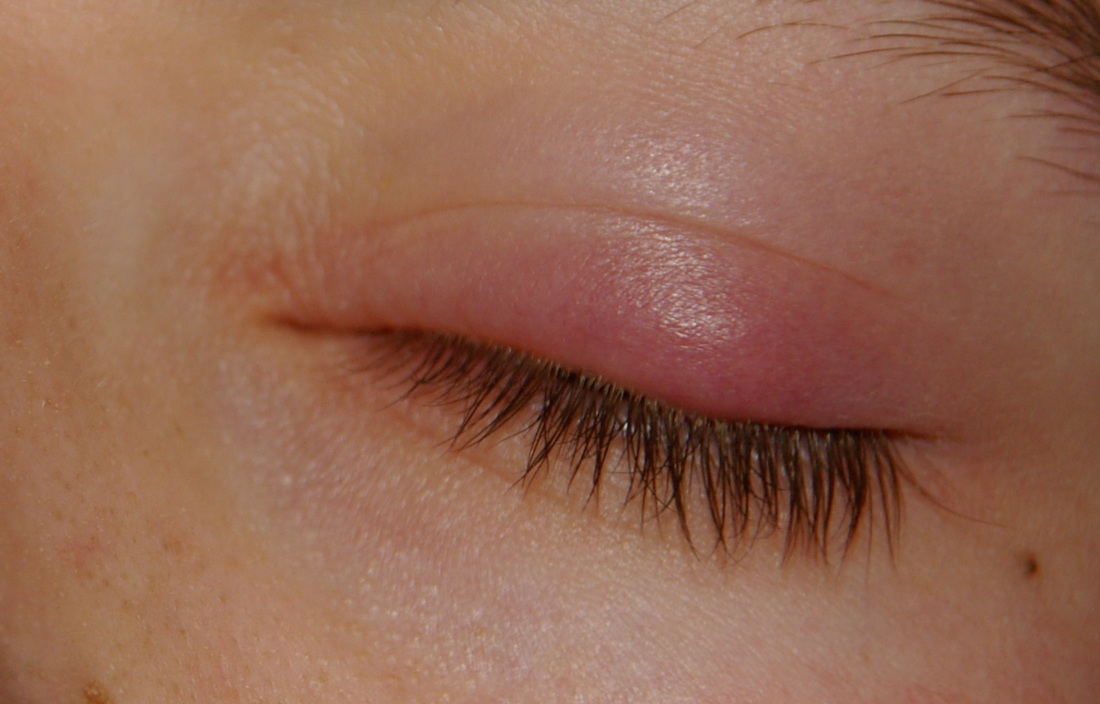 hot compress for cyst on eyelid