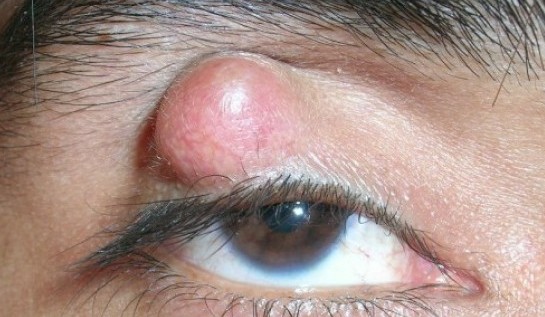 What is a chalazion? Is a chalazion a stye? What does a Chalazion look like?