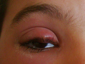 Photograph of stye at the base of eyelash, located on the center upper eyelid.